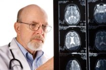 Acidente Vascular Cerebral ou Derrame Cerebral