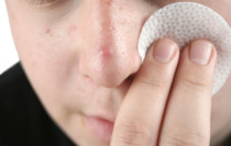 Acne: como melhorar o aspecto da sua pele? Acne: como melhorar o aspecto da sua pele?