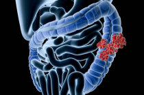Colonoscopia: como &eacute; o exame? Quando deve ser realizado? Para que serve? Quais s&atilde;o os riscos e benef&iacute;cios?
