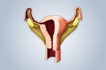 Como &eacute; o c&acirc;ncer de endom&eacute;trio? Por que ele aparece? Quais s&atilde;o os fatores de risco? Como deve ser diagnosticado e tratado? O que fazer para evit&aacute;-lo?