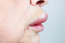 Edema de Quincke: o que &eacute; isso?