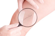 Escleroterapia