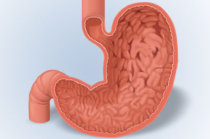 Gastrite enantematosa - como ela é? Gastrite enantematosa - como ela é?