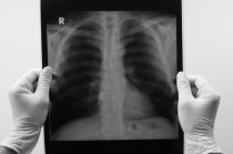 Hipertens&atilde;o pulmonar: o que devo saber sobre ela?
