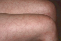 Livedo reticular Livedo reticular