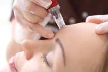 Microagulhamento no tratamento dermatológico Microagulhamento no tratamento dermatológico
