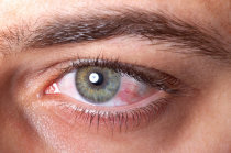 Olhos vermelhos? Pode ser conjuntivite.