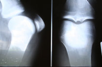 Osteopetrose