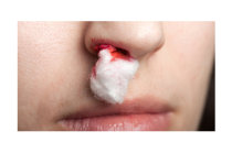 Sangramento nasal ou epistaxe: quais s&atilde;o as causas? O que se deve fazer? O que n&atilde;o fazer quando o nariz sangra? E ap&oacute;s o sangramento?