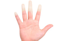 S&iacute;ndrome de Raynaud: como ela &eacute;?
